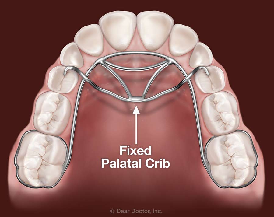 Fixed palatal crib.