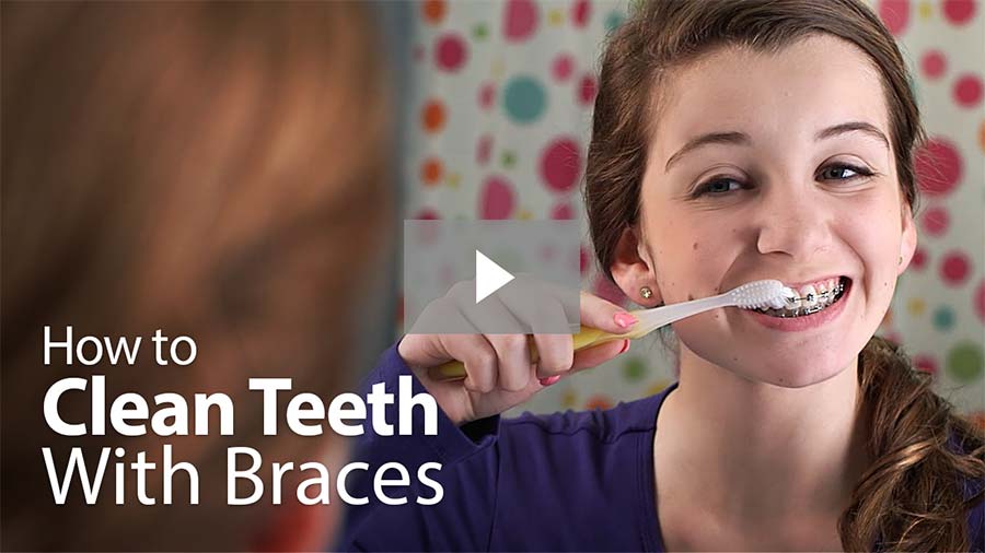 How to clean teeth with braces video