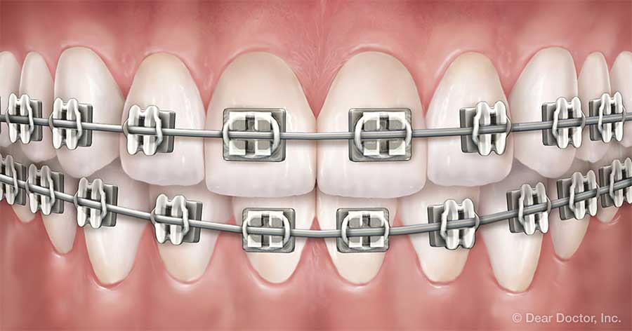 Traditional Metal Braces.