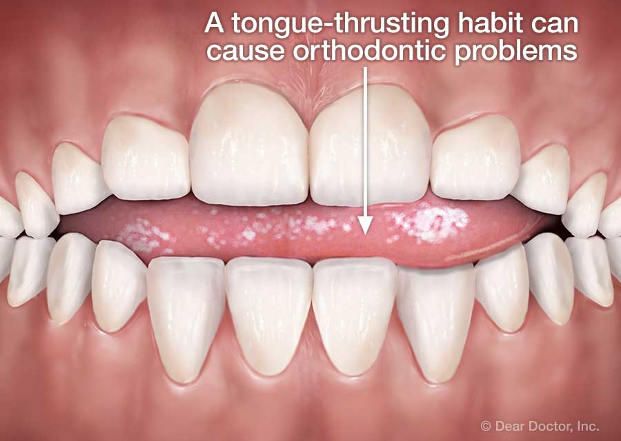 Tongue thrusting habit.
