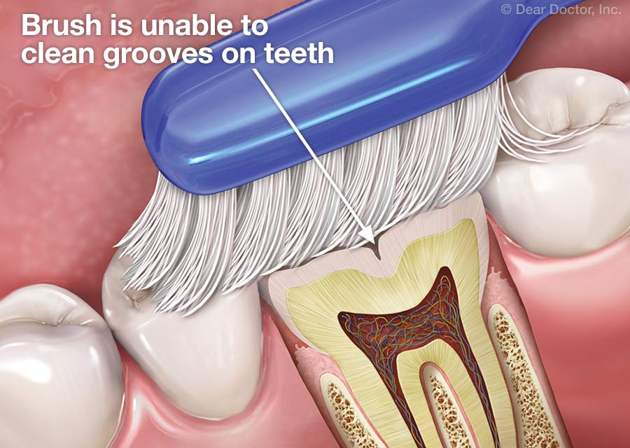 Toothbrush unable to clean grooves in teeth.